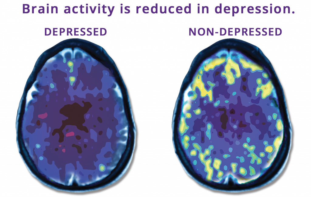 depresyonda beyin nasıl olur
